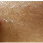 Laser Hair Removal Before & After Patient #250