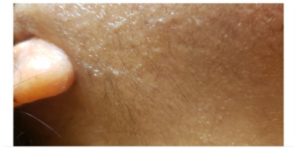 Laser Hair Removal Before & After Patient #250