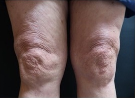 Above Knee fat buldges & skin tightening Before & After Patient #369