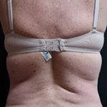 Bra Area Before & After Patient #373