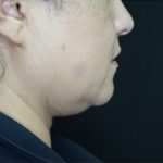 Submental (chin) Before & After Patient #328
