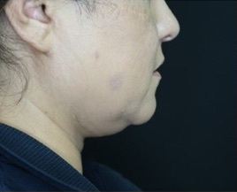 Submental (chin) Before & After Patient #328