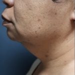 Submental (chin) Before & After Patient #330