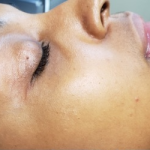 Honey Enzyme Facial Before & After Patient #214