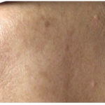 Laser Hair Removal Before & After Patient #249