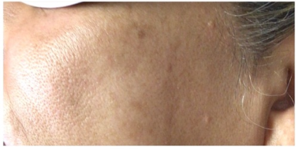 Laser Hair Removal Before & After Patient #249
