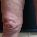 Above Knee fat buldges & skin tightening Before & After Patient #369