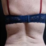 Bra Area Before & After Patient #373