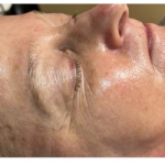 Honey Enzyme Facial Before & After Patient #212