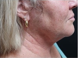 Submental (chin) Before & After Patient #329