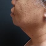 Submental (chin) Before & After Patient #330