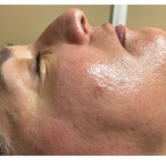 Honey Enzyme Facial Before & After Patient #213