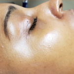 Honey Enzyme Facial Before & After Patient #214