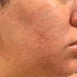 Acne Before & After Patient #196