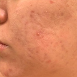 Acne Before & After Patient #196