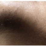 Laser Hair Removal Before & After Patient #252