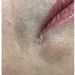 Laser Hair Removal Before & After Patient #253