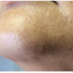 Laser Hair Removal Before & After Patient #251