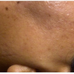Laser Hair Removal Before & After Patient #254