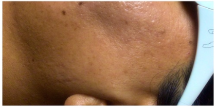 Laser Hair Removal Before & After Patient #254