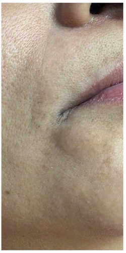 Laser Hair Removal Before & After Patient #253